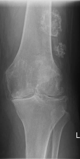 Knstliches Kniegelenk: Behandlung - St. Augustinus-Krankenhaus